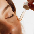 hyperpigmentation